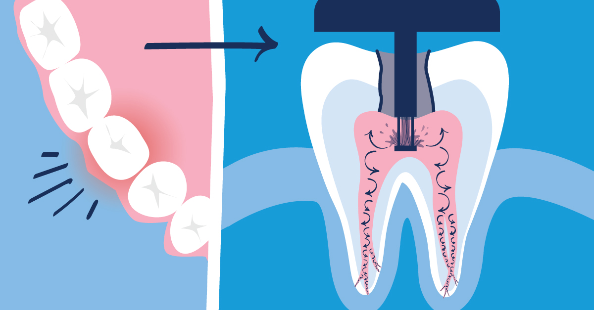 what-to-expect-from-your-root-canal-treatment